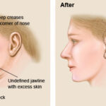 Facelift 3