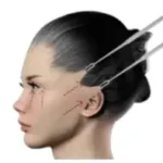 Facelift 4