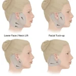 Facelift 5