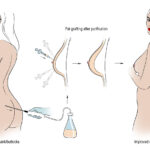 Fat Transfer 1