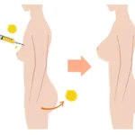 Fat Transfer 2