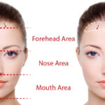 Forehead Reduction 2