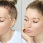 Forehead Reduction 3