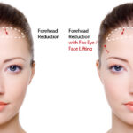 Forehead Reduction 4