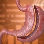 Gastric Bipartition2
