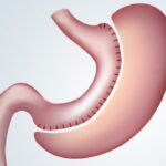 Gastric Bipartition3