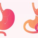 Gastric Bypass