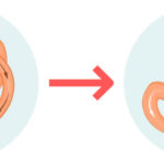 Gastric Bypass2