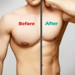 Gynecomastia 1