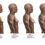 Gynecomastia 3