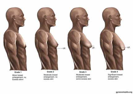 Gynecomastia 3