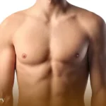 Gynecomastia 4