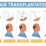 Hair Transplant 1