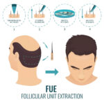 Hair Transplant 3