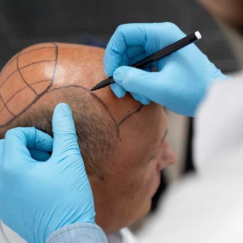 Hair Transplant 4