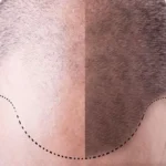 Hair Transplant 5