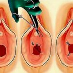 Hymenoplasty 1