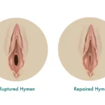 Hymenoplasty 2