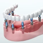 Implant 2