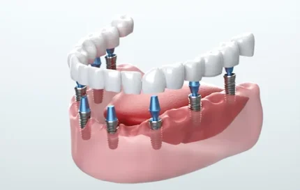 Implant 2