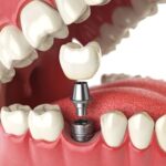 Implant 3