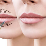 Lip Aesthetics 2