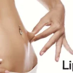 Liposuction 1