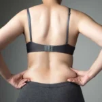 Liposuction 2