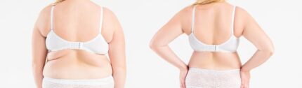 Liposuction 6