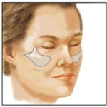 Malar Implants 1