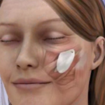 Malar Implants 2