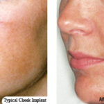 Malar Implants 3