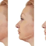 Mentoplasty 1