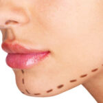 Mentoplasty 2