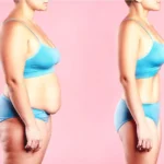 Mommy Makeover 6