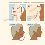 Necklift 3