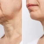 Necklift 4
