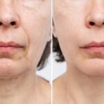 Necklift 5