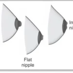 Nipple Aesthetics 1