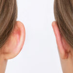 Otoplasty 1