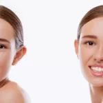 Otoplasty 3