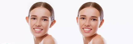 Otoplasty 3