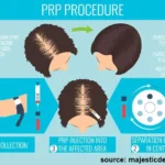 PRP and Mesotherapy 2