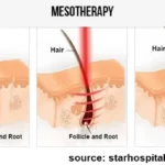 PRP and Mesotherapy 3