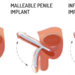 Penis Implants 1
