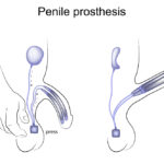 vector illustration of a penile prosthesis. urology