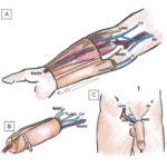 Penis Reconstruction 1