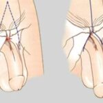 Penoplasty 2