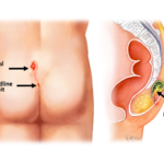 Pilonidal Dimple 1