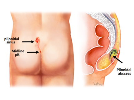 Pilonidal Dimple 1